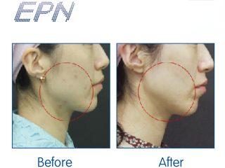 Clearer Jawline and Reduced Blemishes